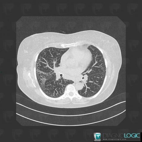 Sarcoïdose, Parenchyme pulmonaire, Scanner