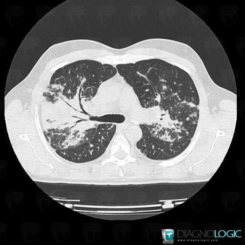 Sarcoïdose, Parenchyme pulmonaire, Scanner