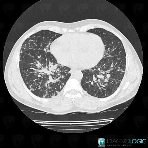Sarcoïdose, Parenchyme pulmonaire, Scanner