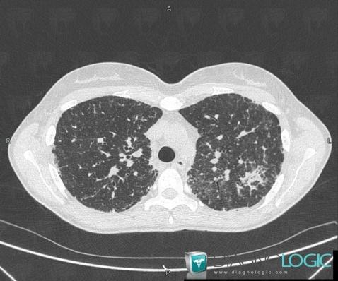 Sarcoïdose, Parenchyme pulmonaire, Scanner