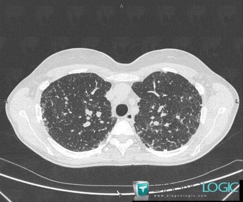 Sarcoïdose, Parenchyme pulmonaire, Scanner