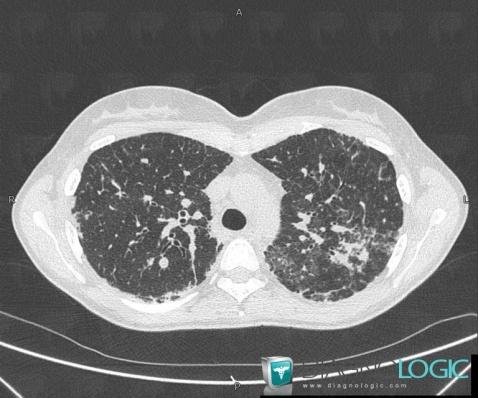 Sarcoïdose, Parenchyme pulmonaire, Scanner