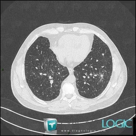 Sarcoïdose, Parenchyme pulmonaire, Scanner