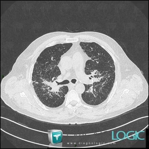 Sarcoïdose, Parenchyme pulmonaire, Scanner