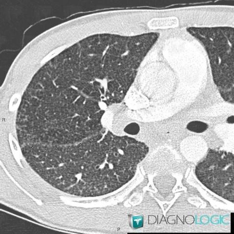 Sarcoïdose, Parenchyme pulmonaire, Scanner