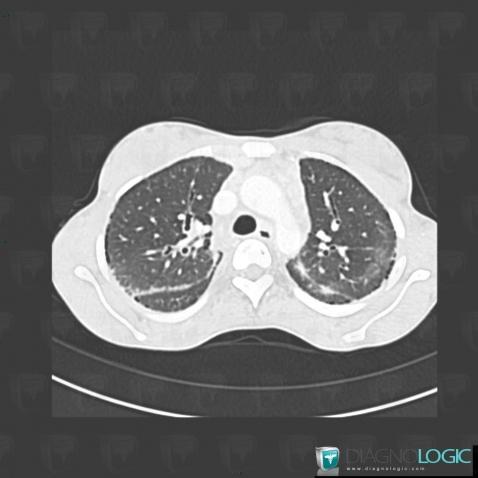 Sarcoïdose, Parenchyme pulmonaire, Scanner