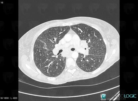 Sarcoïdose, Parenchyme pulmonaire, Scanner