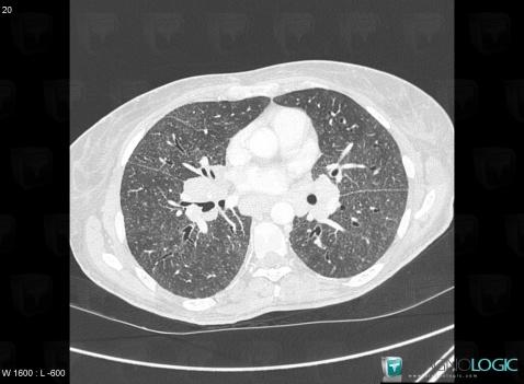 Sarcoïdose, Parenchyme pulmonaire, Scanner