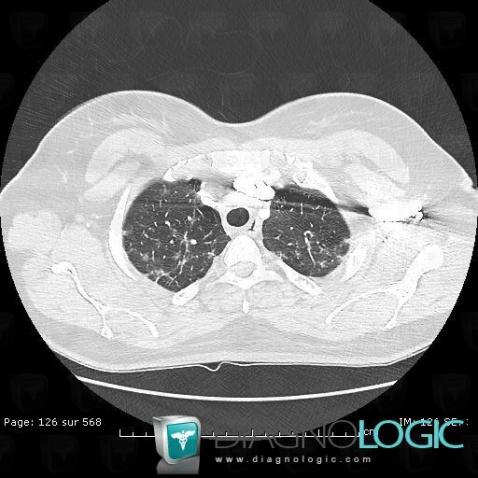 Sarcoïdose, Parenchyme pulmonaire, TDM