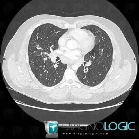 Sarcoïdose, Parenchyme pulmonaire, TDM