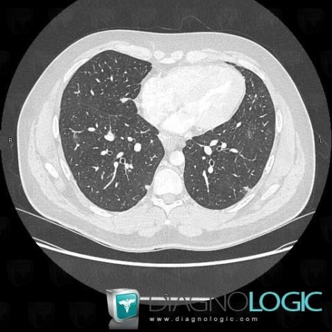 Sarcoïdose, Parenchyme pulmonaire, TDM