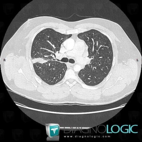 Sarcoïdose, Parenchyme pulmonaire, TDM