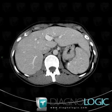 Sarcoïdose, Rate, Scanner