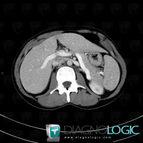 Sarcoïdose, Rate, Scanner