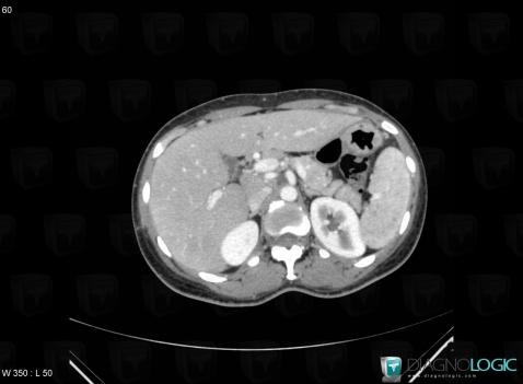 Sarcoïdose, Rate, Scanner