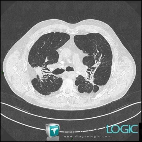 Sarcoidosis, Airways, CT