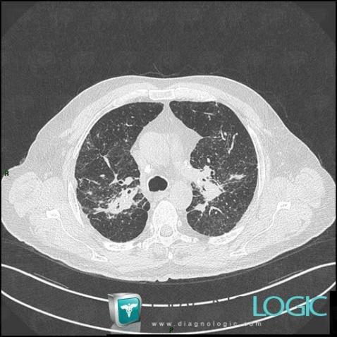 Sarcoidosis, Airways, CT