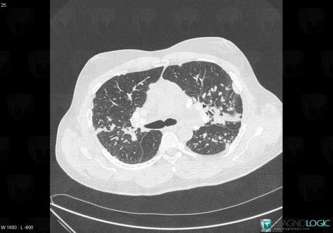 Sarcoidosis, Airways, CT