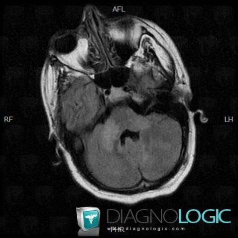 Sarcoidosis, Cerebellar hemisphere, MRI