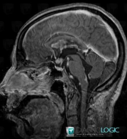 Sarcoidosis, Cerebral hemispheres, Pituitary gland and parasellar region, MRI