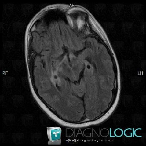 Sarcoidosis, Cerebral hemispheres, Ventricles / Periventricular region, MRI