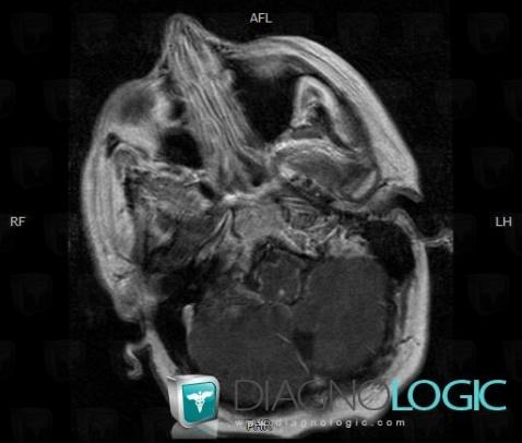 Sarcoidosis, Infratentorial peri cerebral spaces, MRI