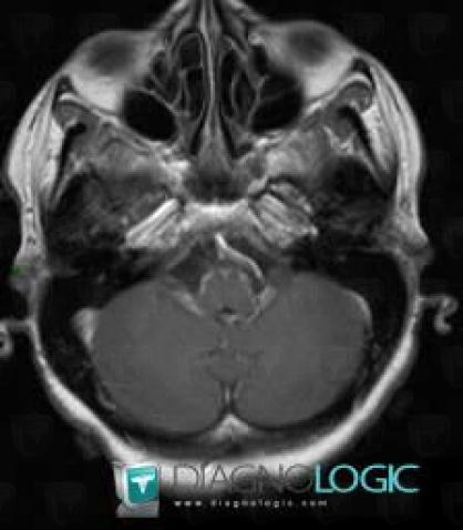 Sarcoidosis, Infratentorial peri cerebral spaces, MRI