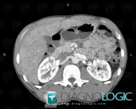 Sarcoidosis, Kidney, CT