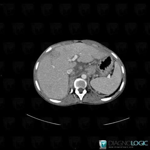 Sarcoidosis, Liver, CT