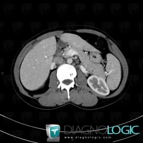 Sarcoidosis, Liver, CT