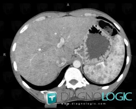 Sarcoidosis, Liver, CT