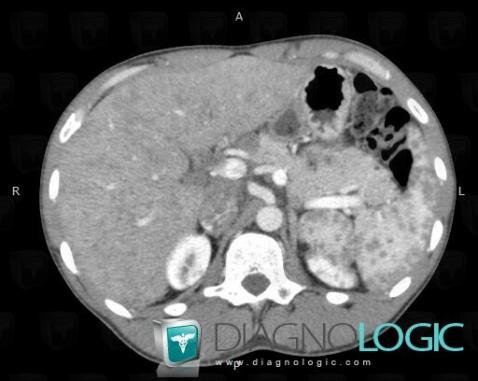 Sarcoidosis, Liver, CT