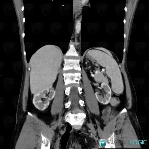 Sarcoidosis, Liver, Spleen, CT