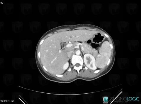 Sarcoidosis, Liver, Spleen, CT