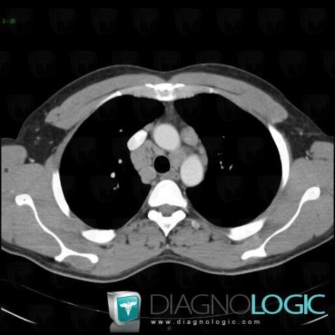 Sarcoidosis, Mediastinum, CT