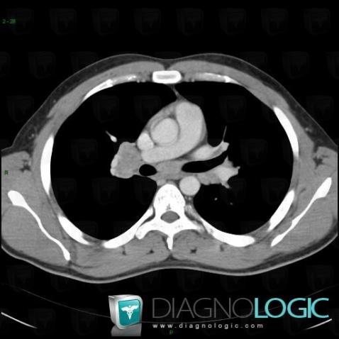 Sarcoidosis, Mediastinum, CT