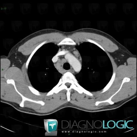 Sarcoidosis, Mediastinum, CT