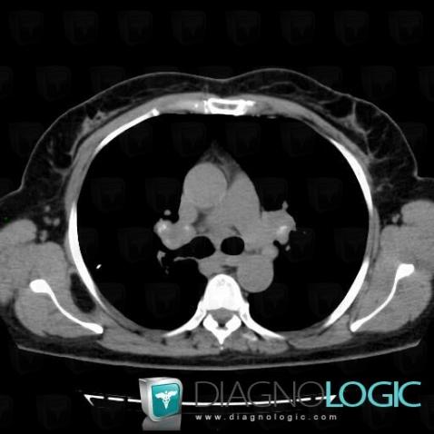 Sarcoidosis, Mediastinum, CT