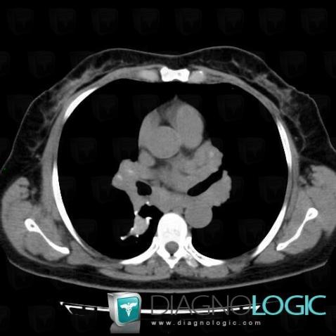 Sarcoidosis, Mediastinum, CT