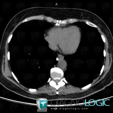 Sarcoidosis, Mediastinum, CT
