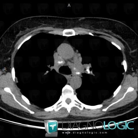 Sarcoidosis, Mediastinum, CT