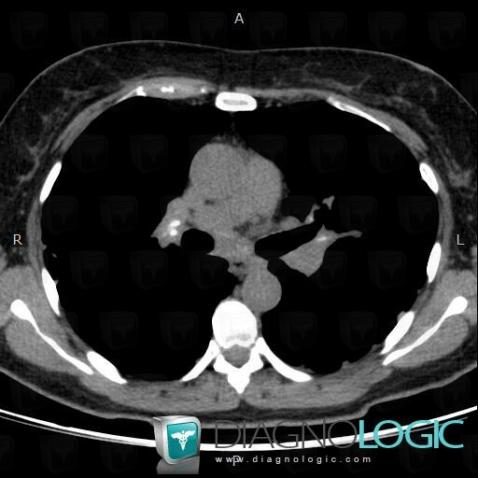 Sarcoidosis, Mediastinum, CT