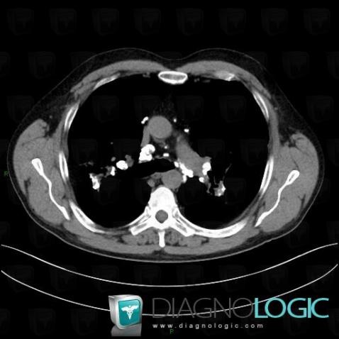Sarcoidosis, Mediastinum, CT