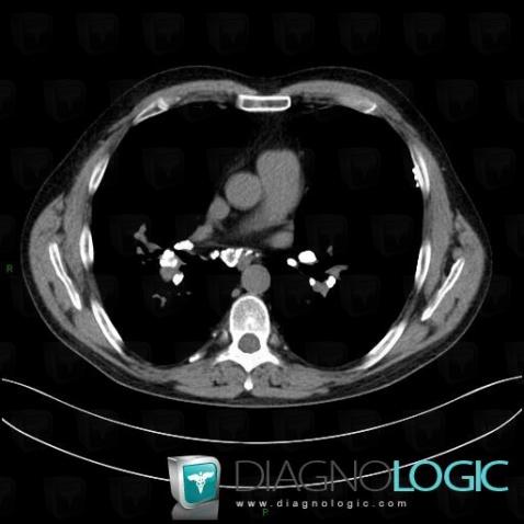 Sarcoidosis, Mediastinum, CT