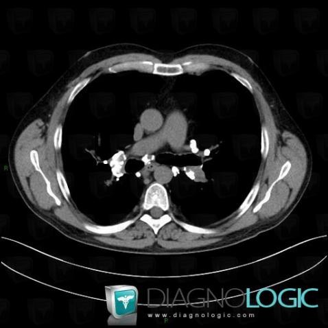 Sarcoidosis, Mediastinum, CT