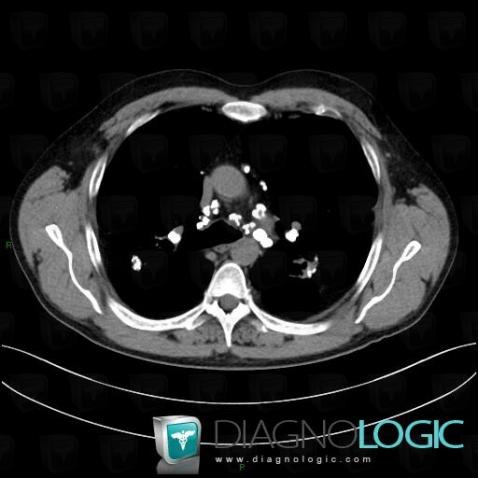 Sarcoidosis, Mediastinum, CT