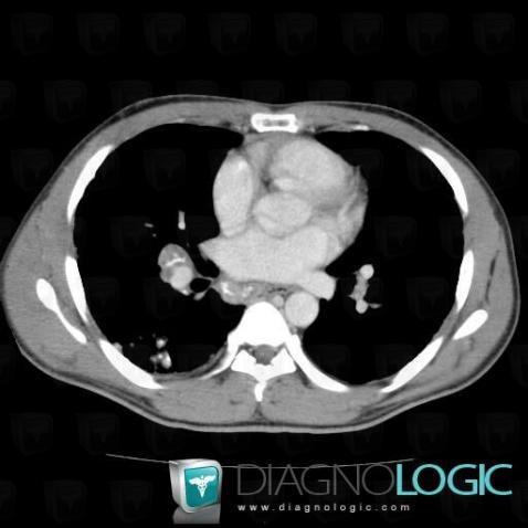 Sarcoidosis, Mediastinum, CT