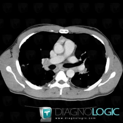 Sarcoidosis, Mediastinum, CT