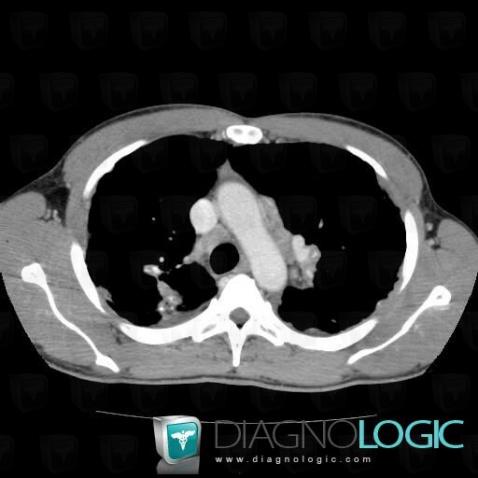 Sarcoidosis, Mediastinum, CT