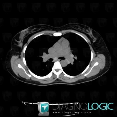 Sarcoidosis, Mediastinum, CT